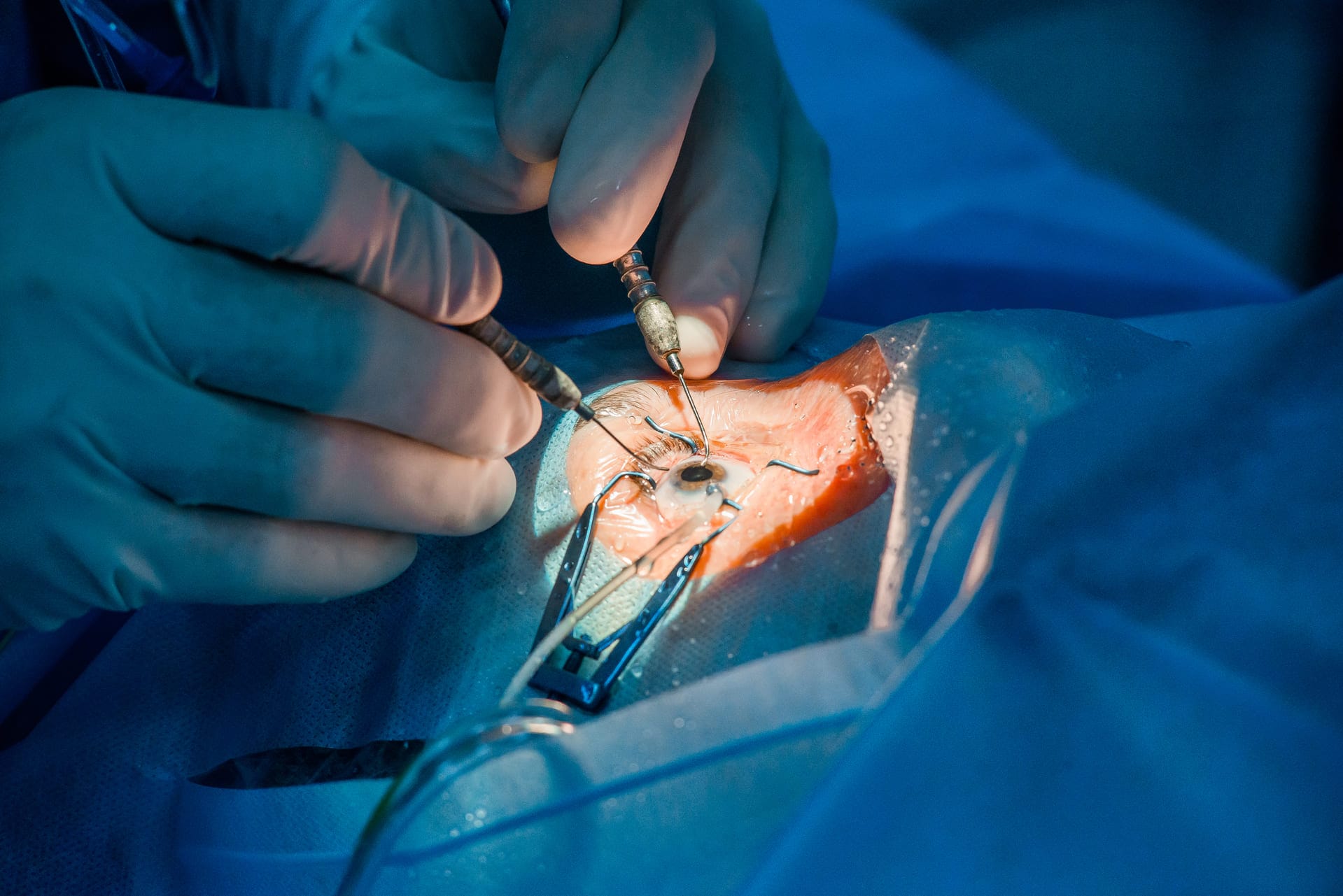 Cirurgia de pterígio sendo realizada por profissional de saúde ocular